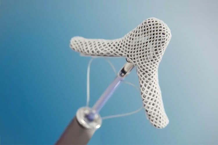 Transcatheter Edge-to-Edge Repair