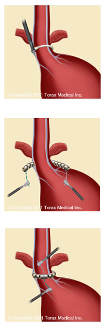 How LINX is implanted