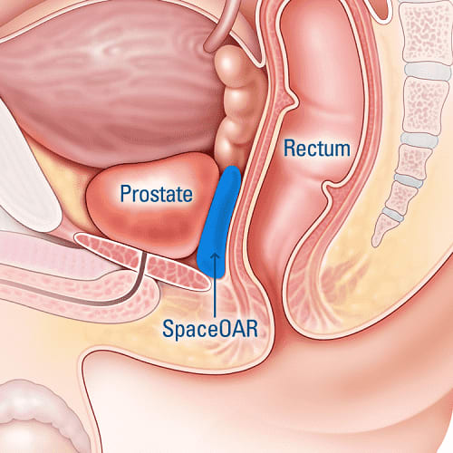 SpaceOAR hydrogel between prostate and rectum, diagram of