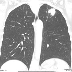 lung xray